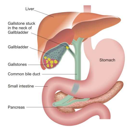 gallstones in the gallbladder gallstones in the gallbladder