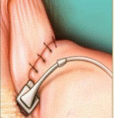 Gastric Band Sutured In Position Gastric-Band-Sutured