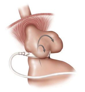 Slipped Gastric Band Slipped Gastric Band