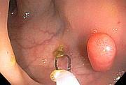 colon polyp about to be removed with snare colon polyp about to be removed with snare