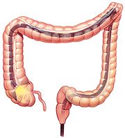 Colonoscopy Colonoscopy