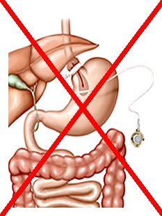 Gastric Banding gastric-banding