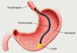 Gastroscopy Gastroscopy