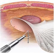 Laparoscopic Repair of Incisional Hernia Laparoscopic Repair of Incisional Hernia