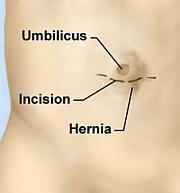 Umbilical Hernia Repair Umbilical Hernia Repair